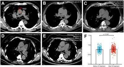 The impact of pulmonary artery to ascending aorta diameter ratio progression on the prognosis of NSCLC patients treated with immune checkpoint inhibitors